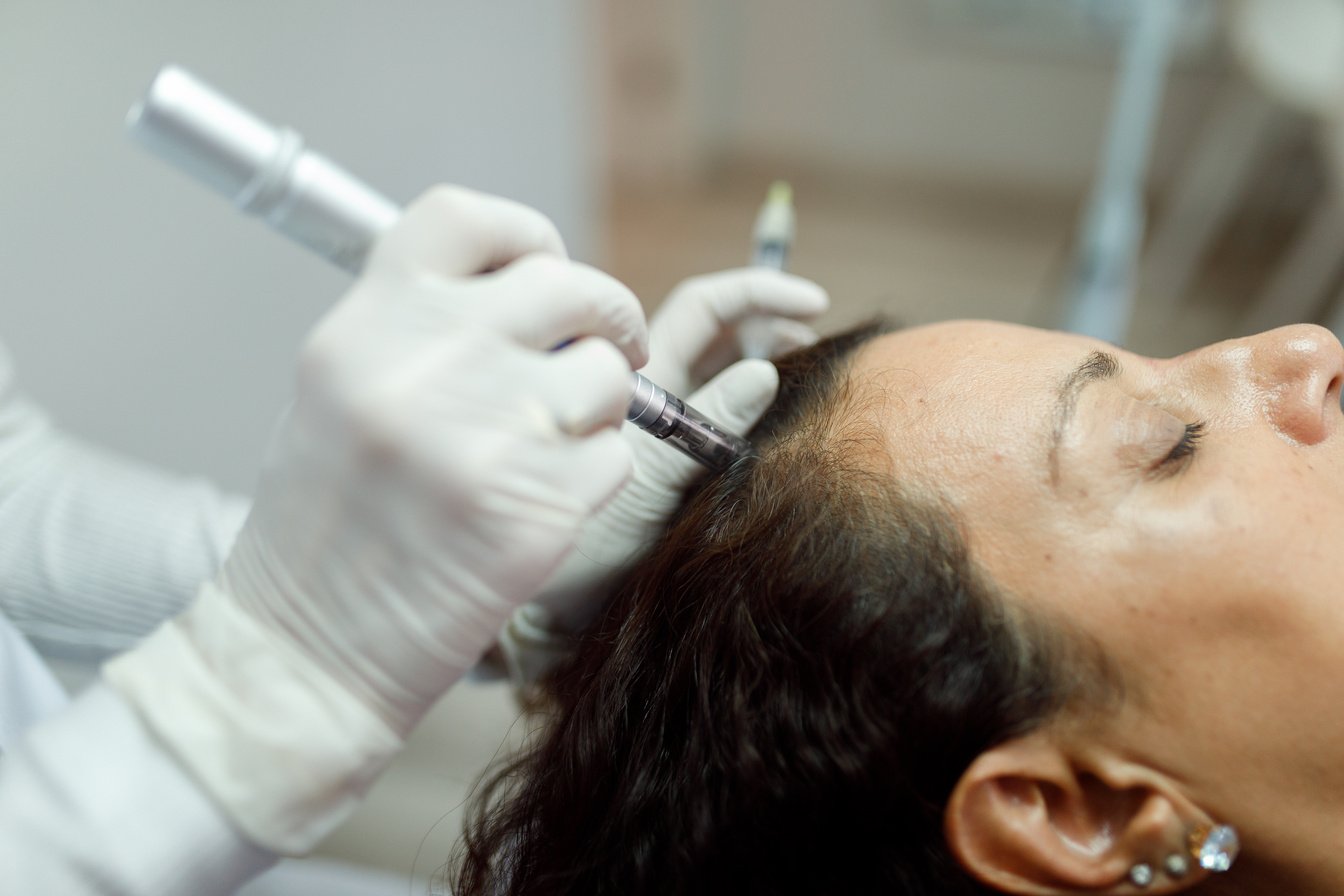 Woman having a microneedling procedure done on her hairline