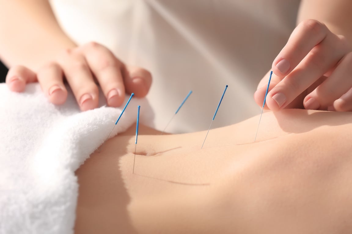 Young Woman Undergoing Acupuncture Treatment